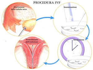 Fecondazione in vitro