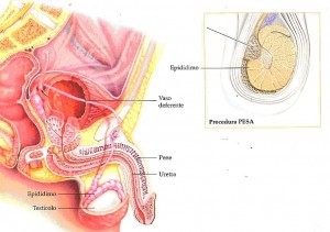 aspirazione degli spermatozoi dall’epididimo