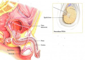 aspirazione degli spermatozoi dall’epididimo