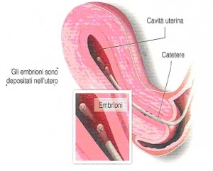 embryo_transfer