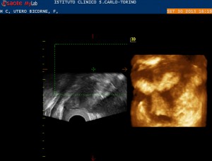 Ecografia 3D e malformazioni uterine: utero bicorne in cui ha potuto instaurarsi una gravidanza mediante fecondazione assistita