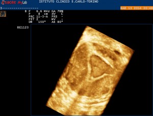 cavita-uterina-in-3-4D