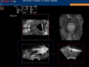 cavita-uterina-valutata-in-2-3D