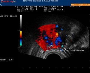 perviet&agrave; tubarica destra al color doppler