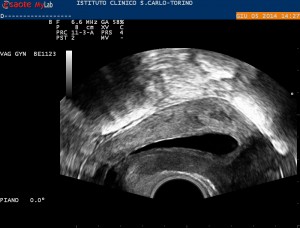 Sonoisterografia in 2D: cavità uterina normale