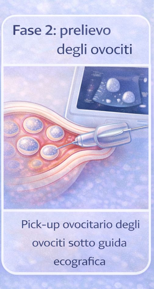 prelievo degli ovociti pick up ovocitario sotto guida ecografica nella fecondazione in vitro